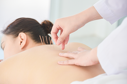 Acupuncture Description